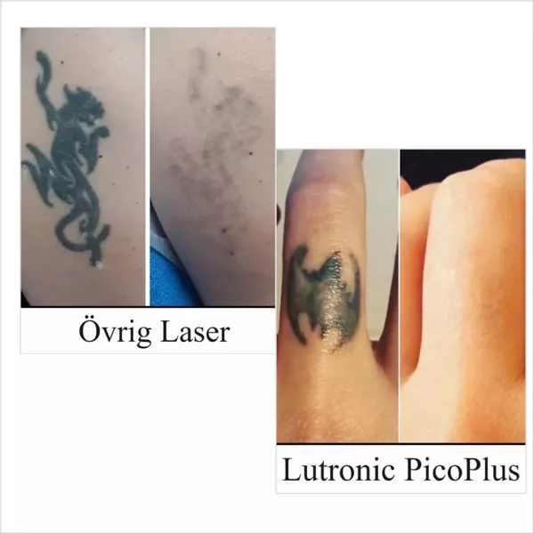 Tatueringsborttagning med Lutronic PicoPlus jämfört med Q-switch – fullständigt borttagen tatuering utan ärr, KeraLase Laser Kliniken Malmö Göteborg Jönköping