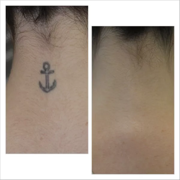 Tatueringsborttagning på nacken före och efter Lutronic PicoPlus – huden helt återställd utan ärr, KeraLase Laser Kliniken Malmö Göteborg Jönköping