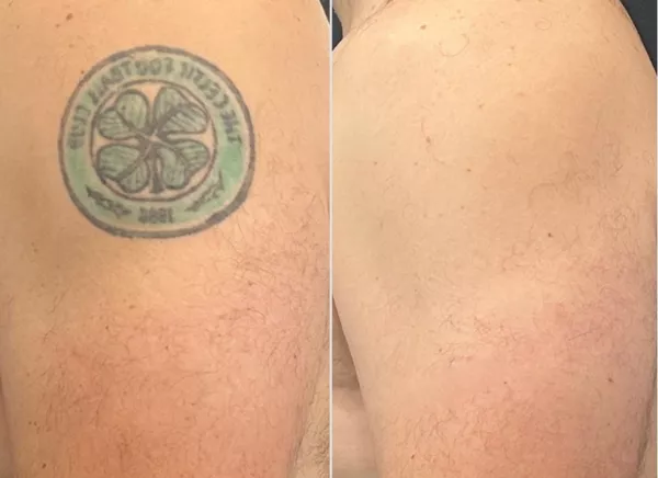 Före och efter färgglad tatuering borttagen helt med Lutronic PicoPlus laser i Malmö, Göteborg och Jönköping – inga ärr, inga skador, perfekt resultat från KeraLase