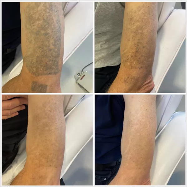 Tatueringsborttagning steg för steg – före behandling, efter första, andra och tredje sessionen med Lutronic PicoPlus, KeraLase Laser Kliniken Malmö Göteborg Jönköping