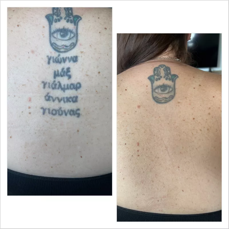 Före och efter tatueringsborttagning med Lutronic PicoPlus – tatueringen helt borta och huden slät, KeraLase Laser Kliniken i Malmö Göteborg och Jönköping