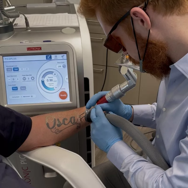Tatueringsborttagning med Lutronic PicoPlus laser i Malmö, Göteborg och Jönköping – synlig frosting och delvis blekt tatuering under pågående laserbehandling på KeraLase